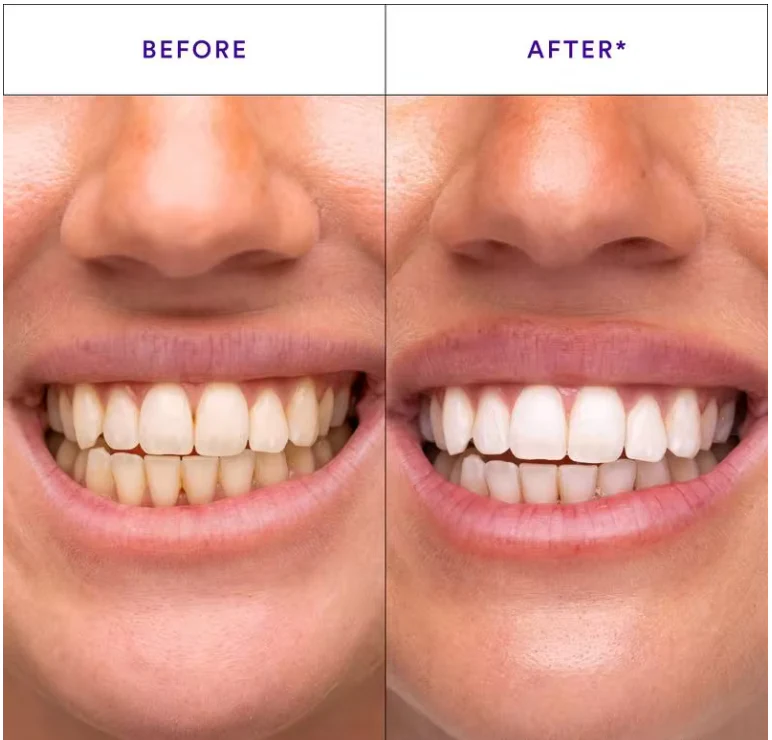 (New) Bandes Dentaires Violettes Anti-Jaunissement "Formule Concentré" ⭐️ - ventix