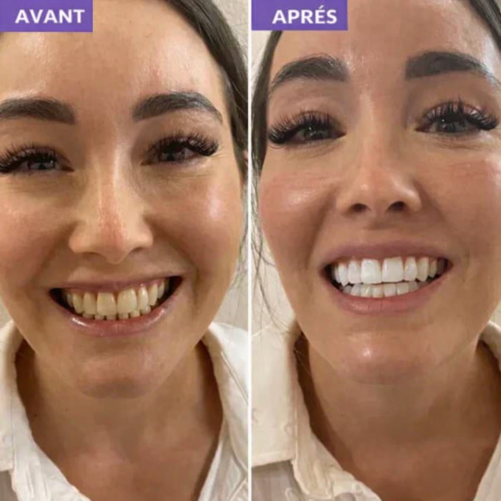 (New) Bandes Dentaires Violettes Anti-Jaunissement "Formule Concentré" ⭐️ - ventix