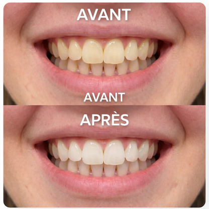 (New) Bandes Dentaires Violettes Anti-Jaunissement "Formule Concentré" ⭐️ - ventix